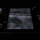 Carcinoma of sigmoid colon, metastasis of liver: US - Ultrasound